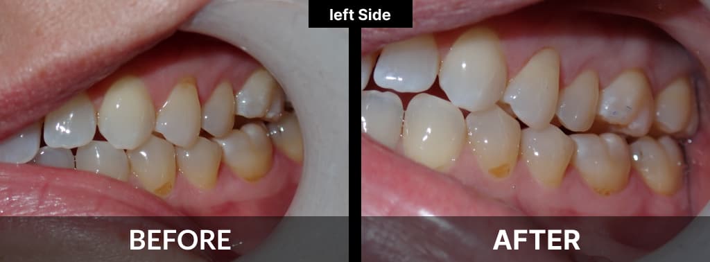 Tooth Colored Resin Fillings