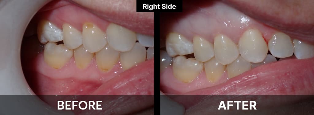 Tooth Colored Resin Fillings