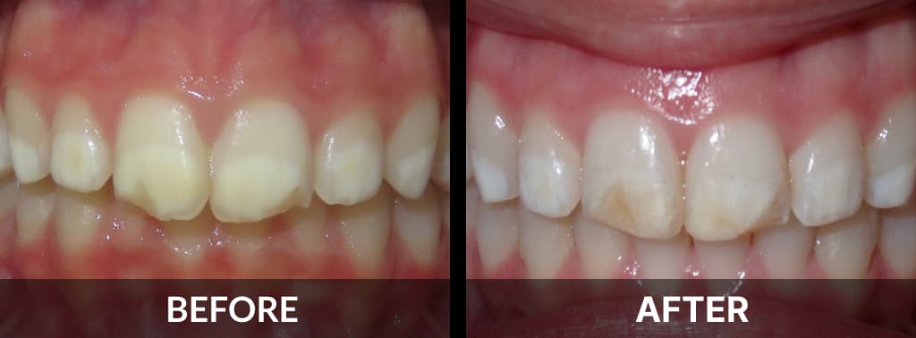 Before After Invisalign