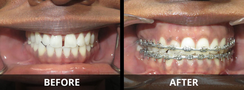 braces-before-after