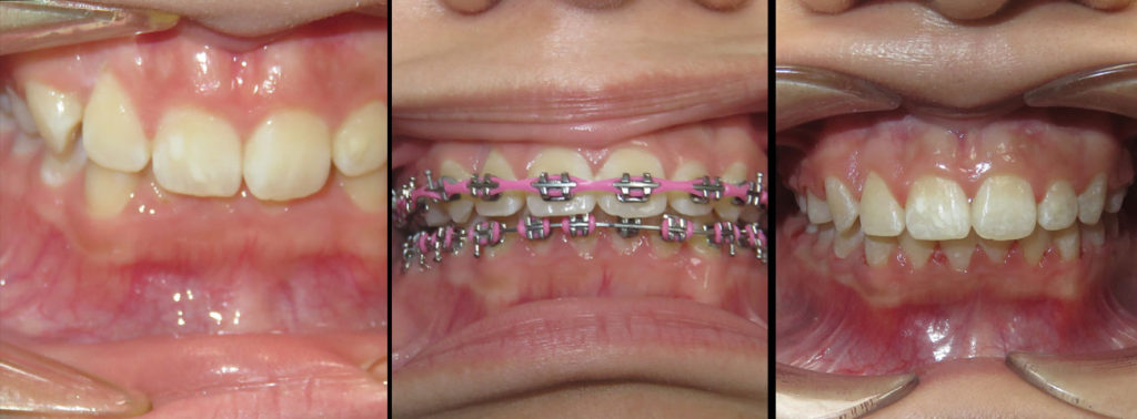 braces-before-after