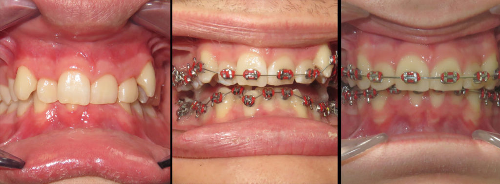 braces-before-after