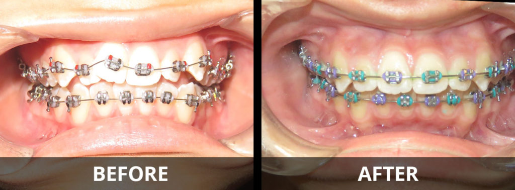 braces-before-after