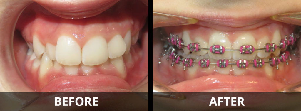 braces-before-after