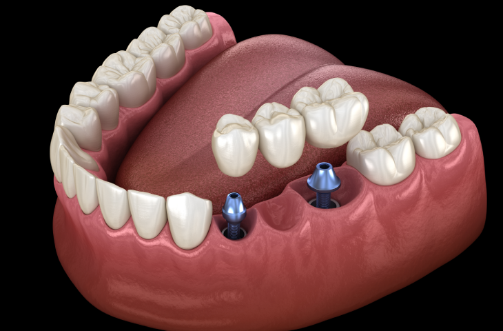 Dental Bridges