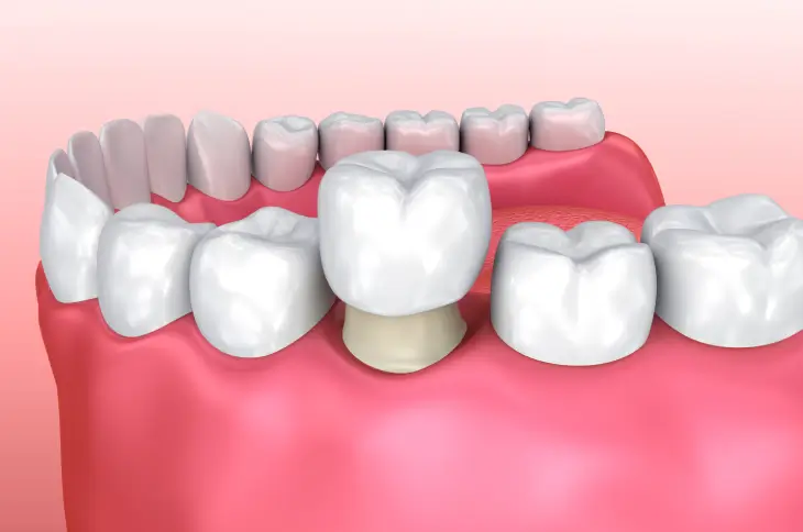 Dental Crowns