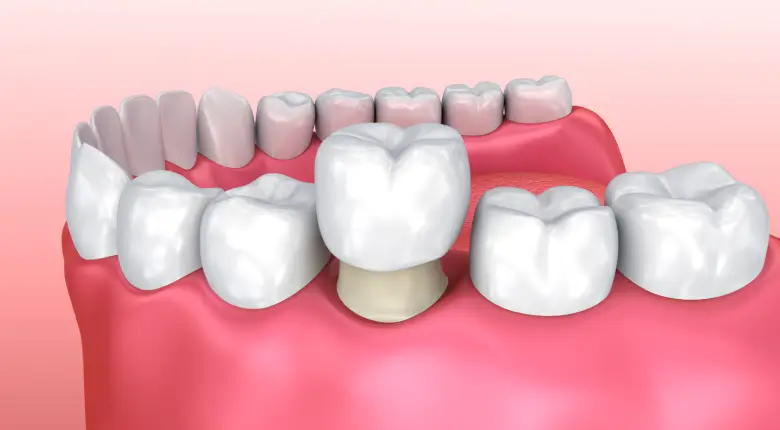 Dental Crowns