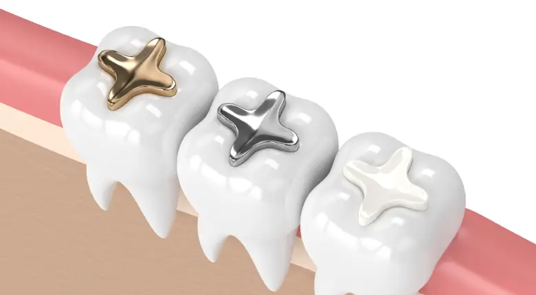 Porcelain Inlays and Onlays