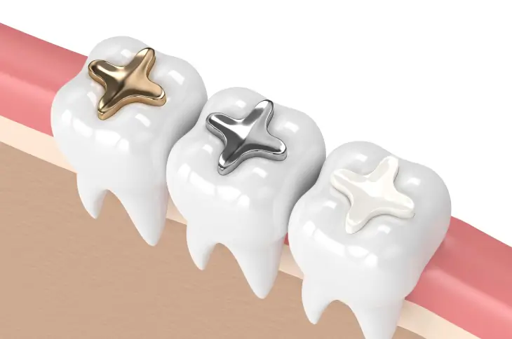 Porcelain Inlays and Onlays