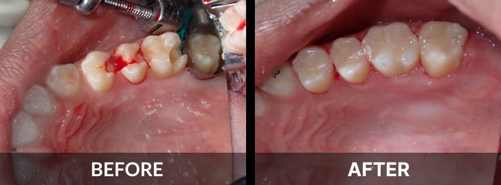 Filling- Cass Before After