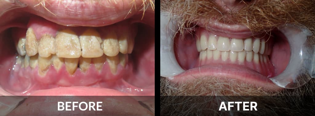 Full Denture Before After