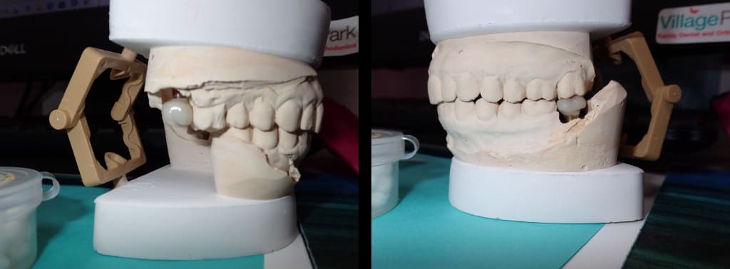 Implant Image Process