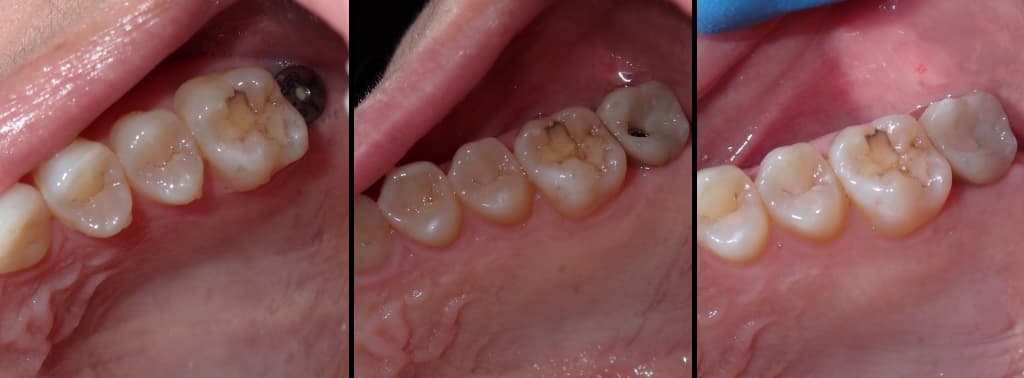 Implant Image Process