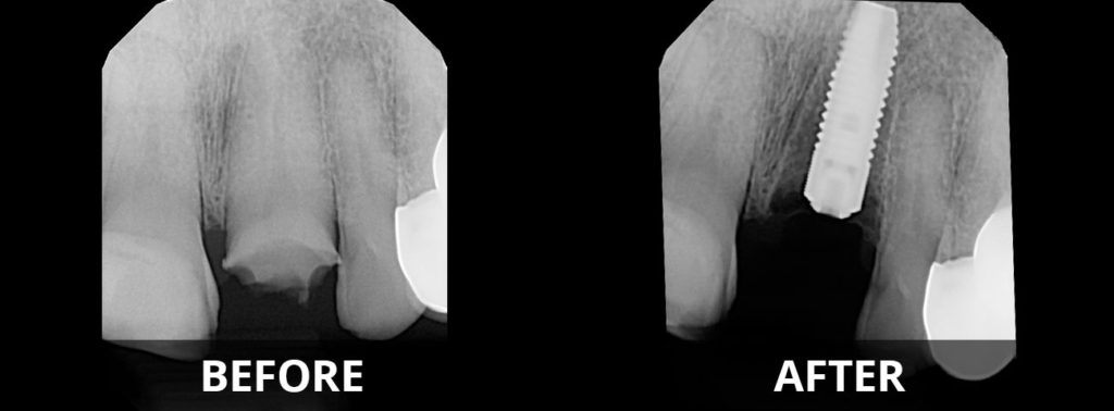 implants-before-after