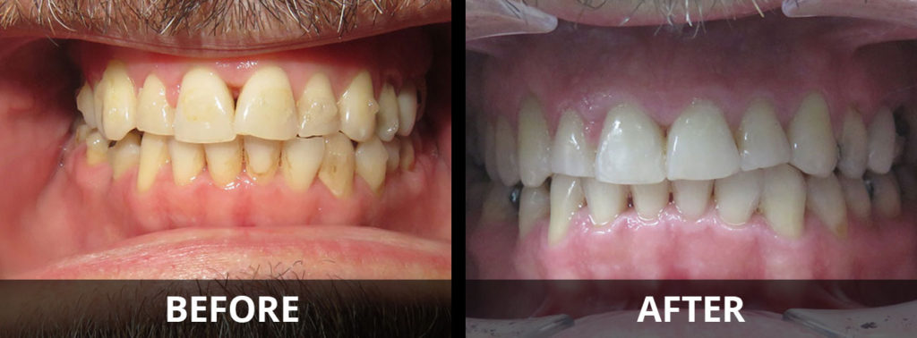 invisalign-before-after