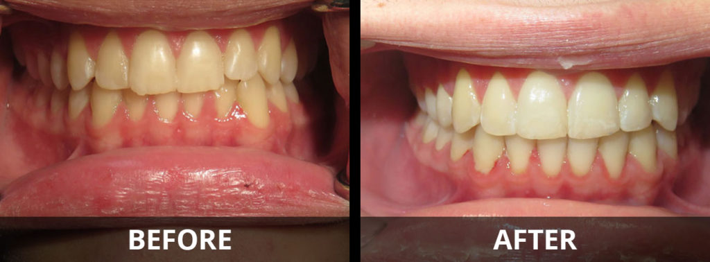 invisalign-before-after