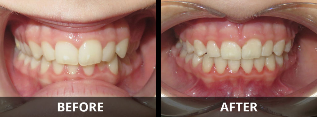 invisalign-before-after