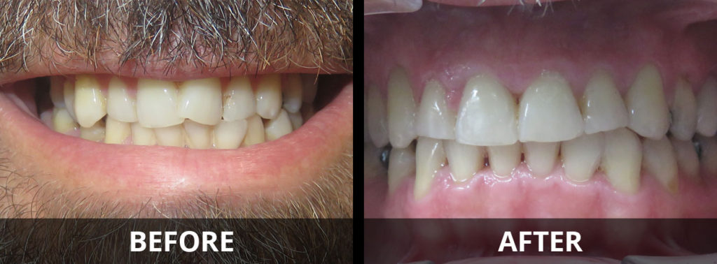 invisalign-before-after