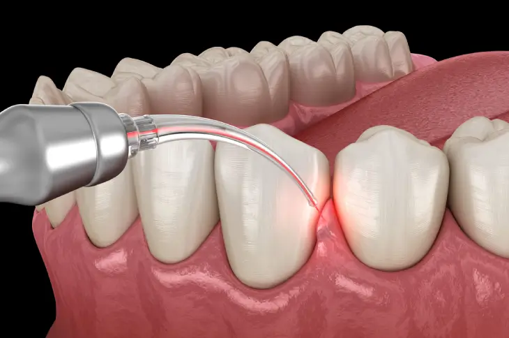 Laser Dentistry and Gum Recontouring