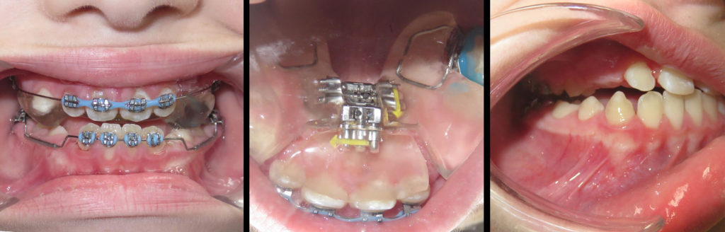 orthodontics-before-after