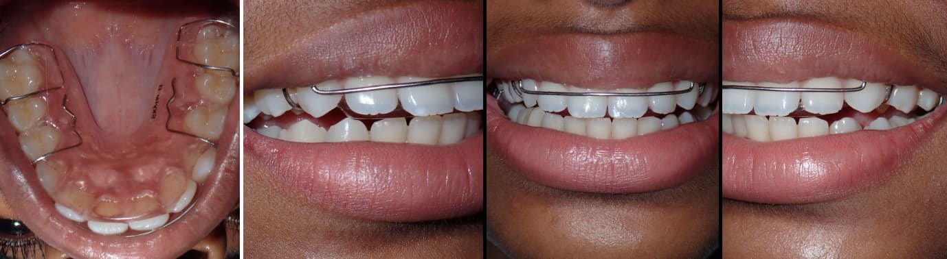 Retainer Smile Make Over