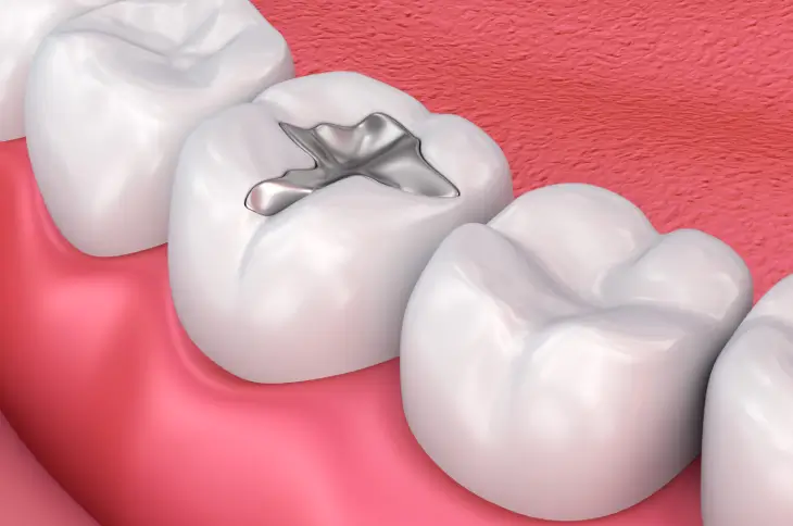 Tooth-Colored Fillings