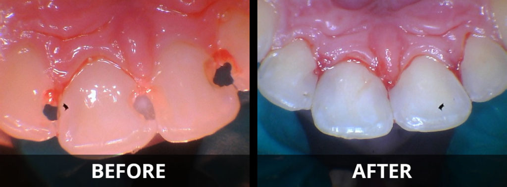 tooth-colored-resin-fillings-before-after