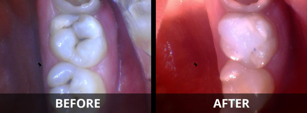 tooth-colored-resin-fillings-before-after