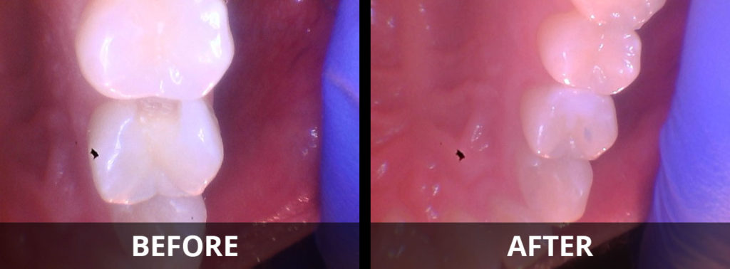 tooth-colored-resin-fillings-before-after