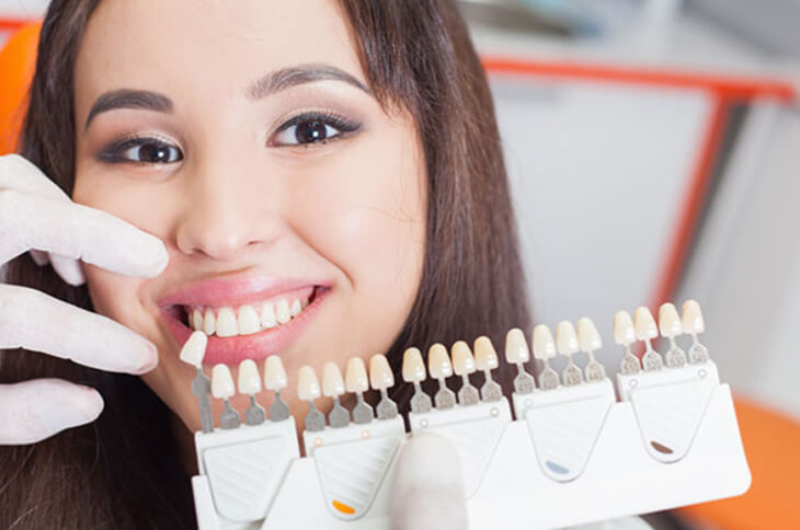 Veneers in Cypress, TX