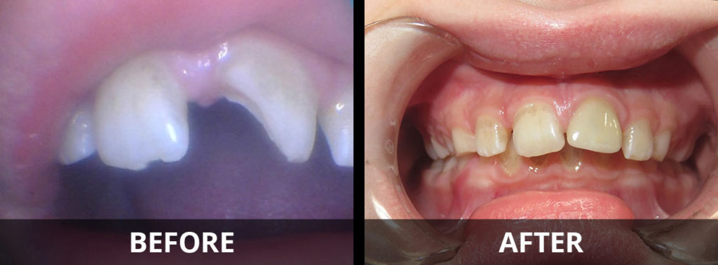 zirconia-crowns-before-after