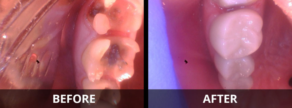 zirconia-crowns-before-after